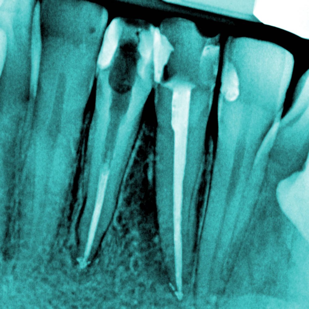 LECZENIE KANAŁOWE (ENDODONCJA)